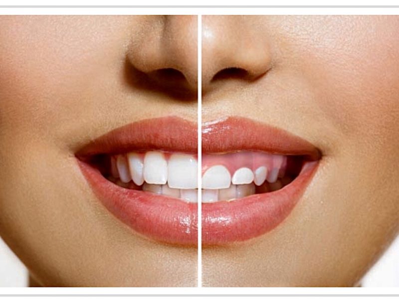 gingivectomia-sonrisa-gingival